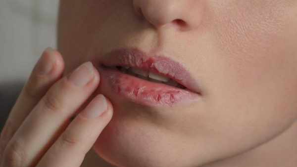 Penyebab dan Cara Mengatas Bibir Kering